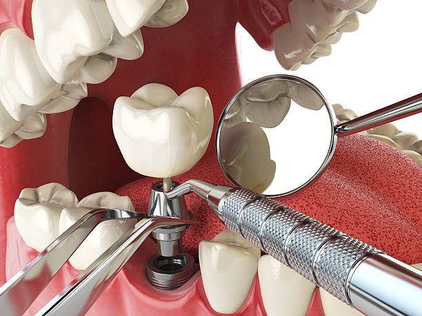 Best Chipped Tooth Repair Near Me  in North Fort Myers, FL